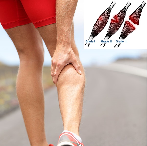 Sofocar Sangrar Desigualdad Rotura de fibras o desgarro muscular. Tratamiento, ejercicios y  recuperación - Clínica Levante